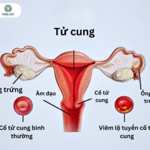 Viêm Lộ Tuyến Tử Cung ở Phụ Nữ