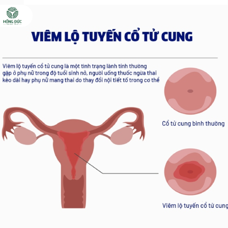Thuốc trị viêm lộ tuyến: Hướng dẫn chi tiết từ chuyên gia phụ khoa 2 Viêm Lộ Tuyến Cổ Tử Cung
