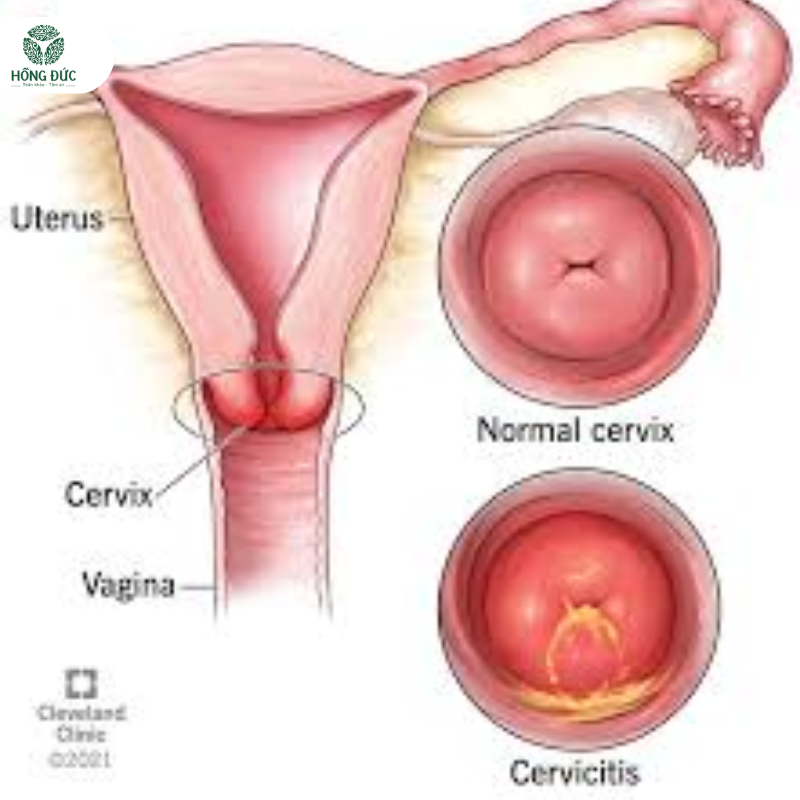 Cách điều trị viêm lộ tuyến cổ tử cung hiệu quả: Từ thuốc đến công nghệ hiện đại 1 Viêm Lộ Tử Tuyến Cổ Tử Cung là gì?