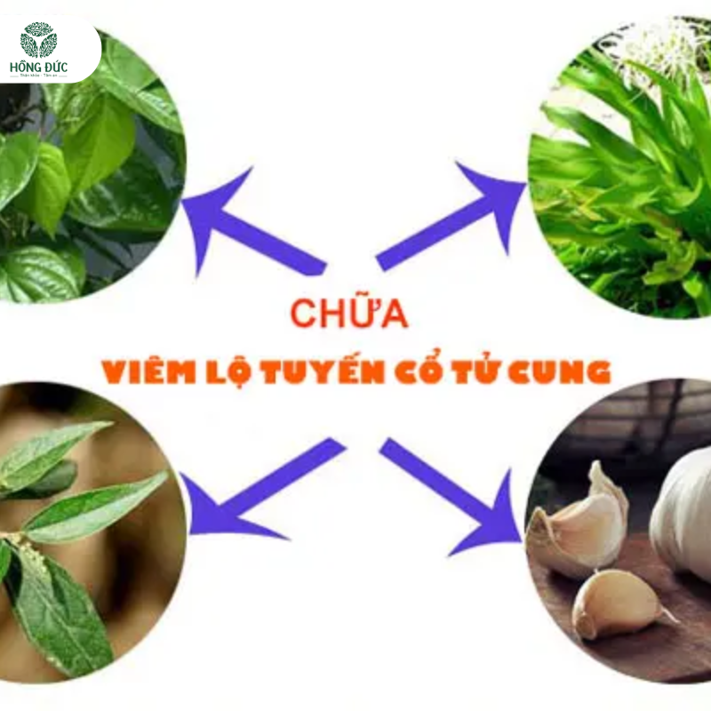 Cách điều trị viêm lộ tuyến cổ tử cung hiệu quả: Từ thuốc đến công nghệ hiện đại 4 Các phương pháp điều trị lành tính