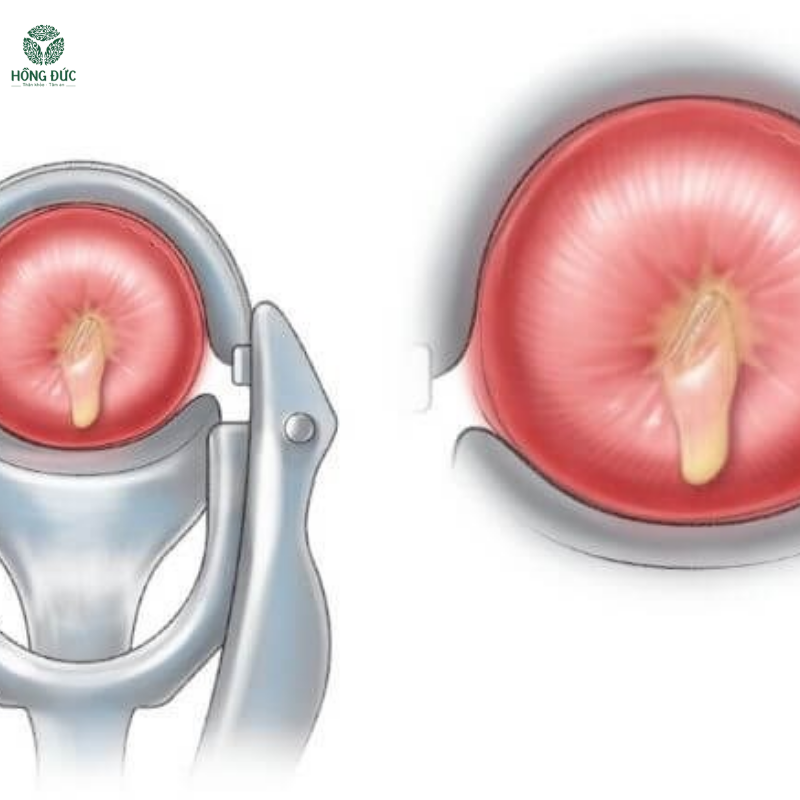 Viêm Lộ Tuyến Cổ Tử Cung