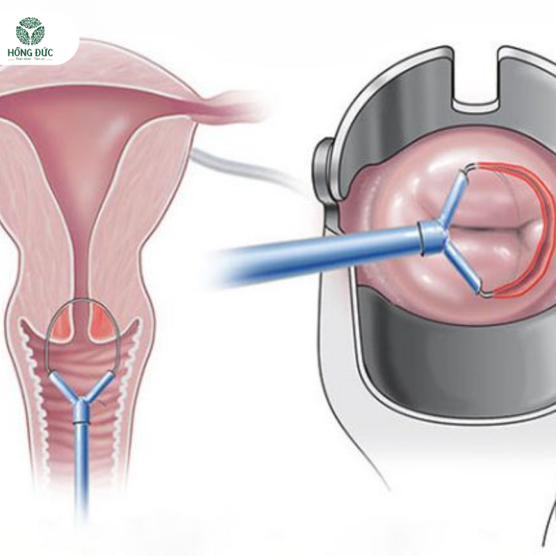 Phương pháp điều trị Viêm Lộ Tuyến Cổ Tử Cung
