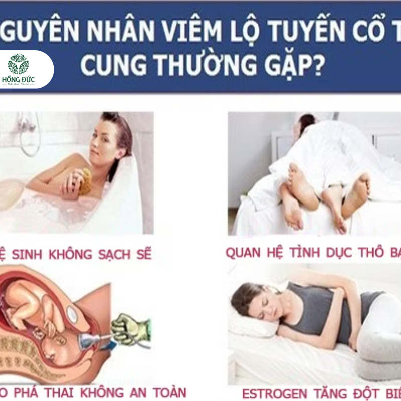 Những nguyên nhân gây ra Viêm Lộ Tuyến Cổ Tử Cung