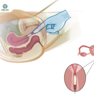 Hướng dẫn sử dụng thuốc trị viêm lộ tuyến cổ tử cung