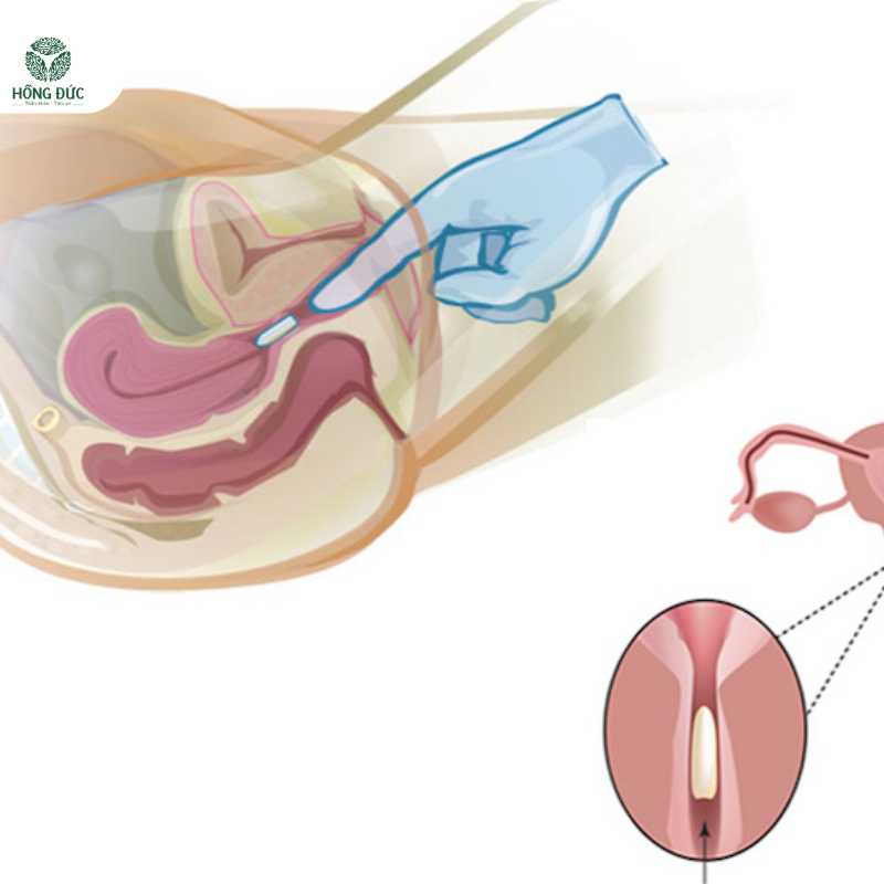 Hướng dẫn sử dụng thuốc trị viêm lộ tuyến cổ tử cung