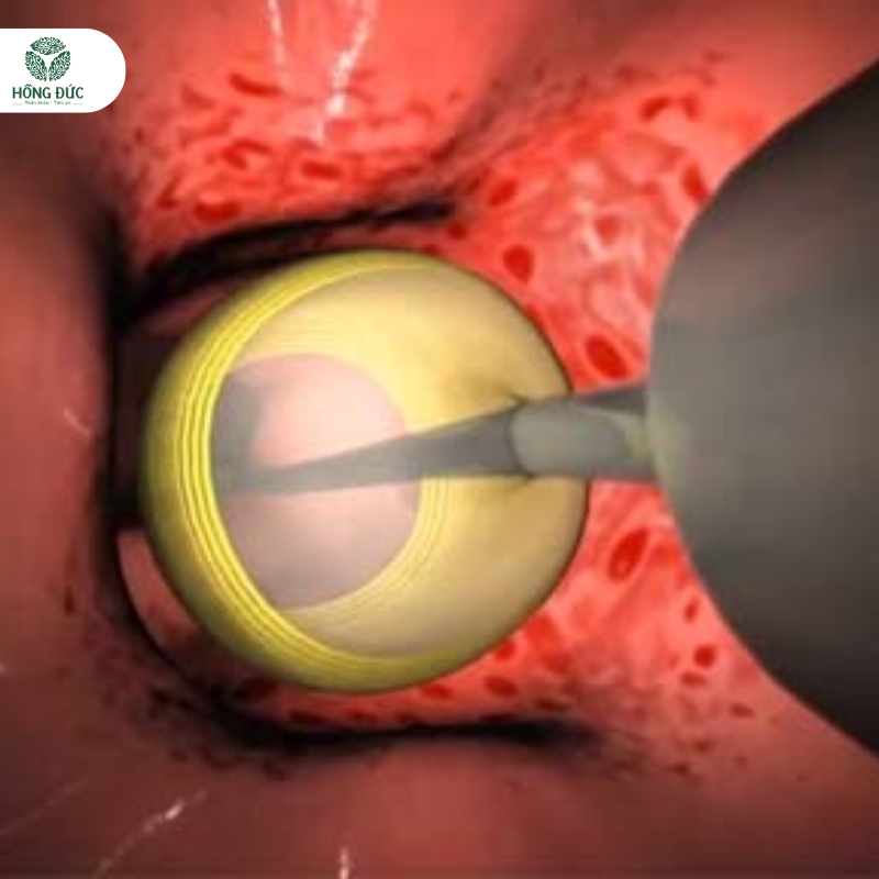 Chi phí điều trị viêm lộ tuyến cổ tử cung: Cập nhật mới nhất và những điều cần biết 1 Viêm Lộ Tuyến Cổ Tử Cung