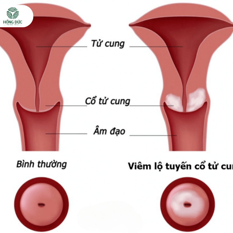 Phác đồ điều trị viêm lộ tuyến tử cung: Hướng dẫn chi tiết và hiệu quả 2 6