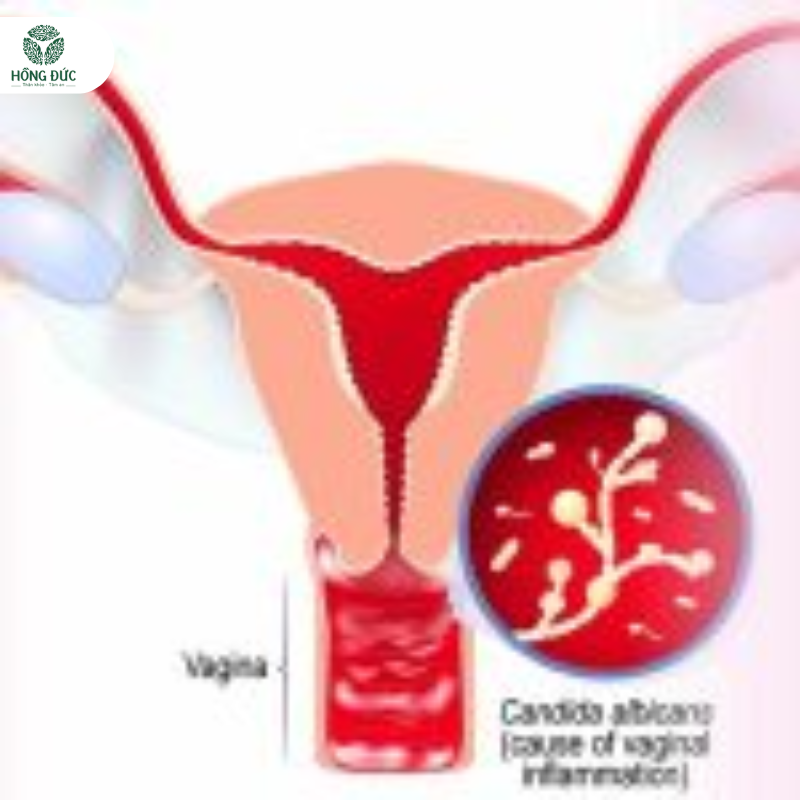 Điều trị Huyết Trắng tại nhà 